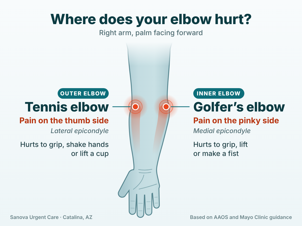Tennis elbow vs golfer's elbow diagram - Sanova Urgent Care Tennis elbow vs golfer's elbow diagram: outer elbow pain on the thumb side vs inner elbow pain on the pinky side